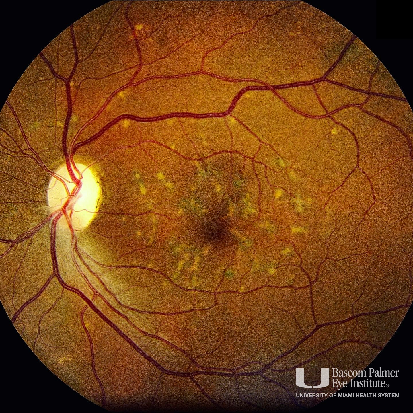 MP101921OI Multifocal Pattern Dystrophy